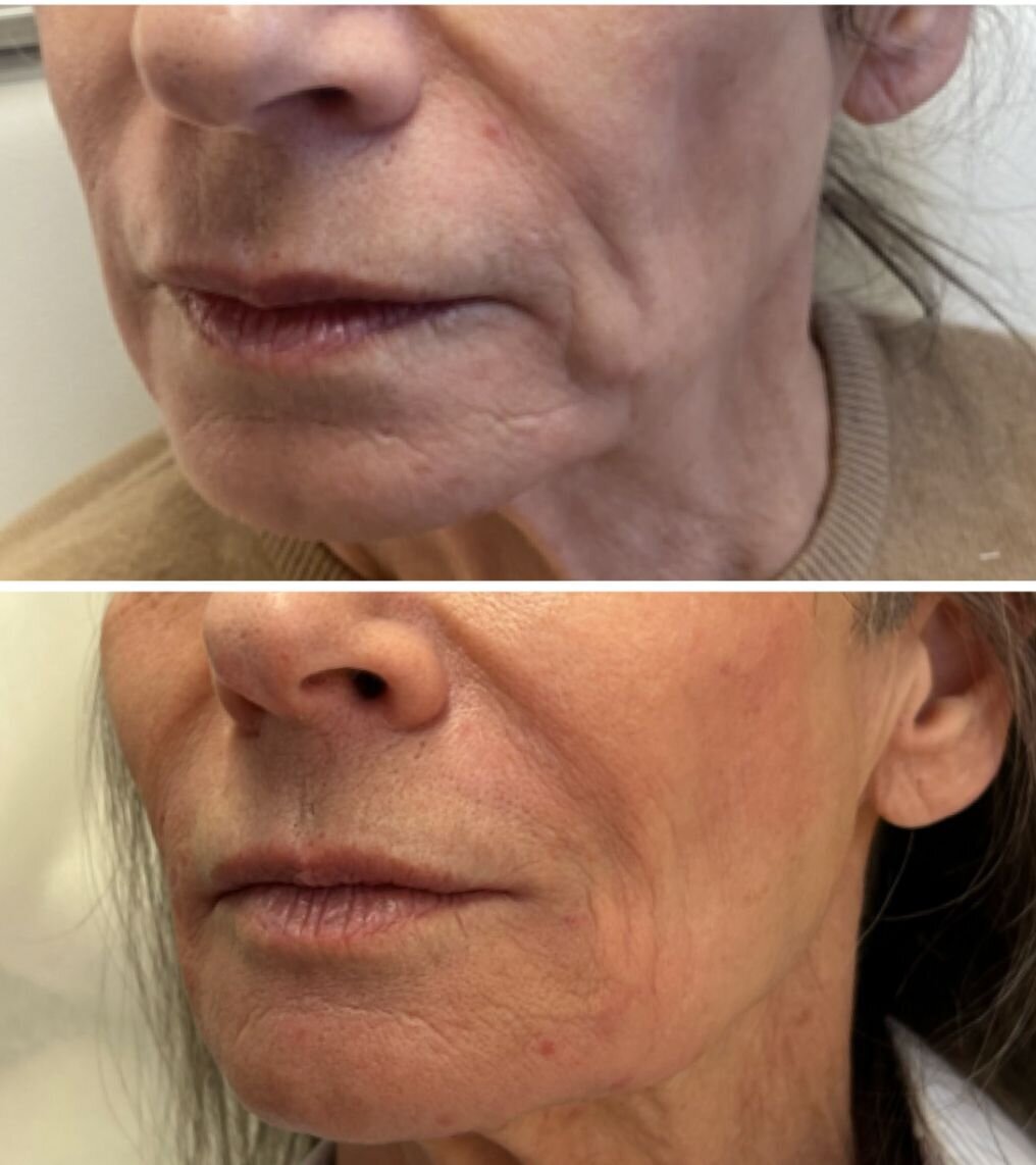 compressed-Sofwave-brand-pics-and-before-after -09