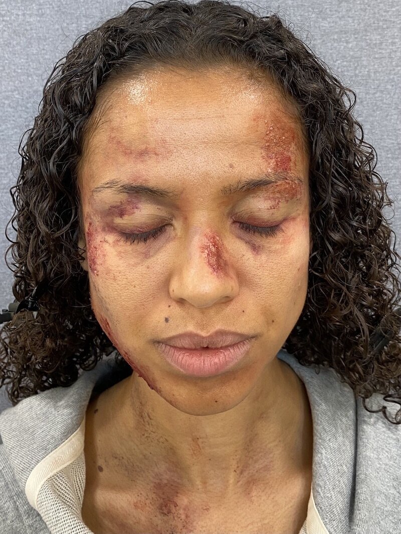 woman-fake-bruises-scrapes-face-makeup-fx