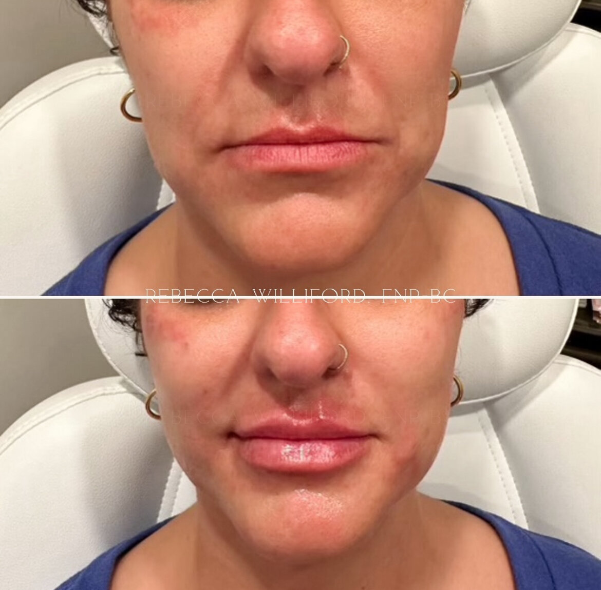 Lip Filler by Rebecca Williford at The Rae Clinic in Augusta, Georgia