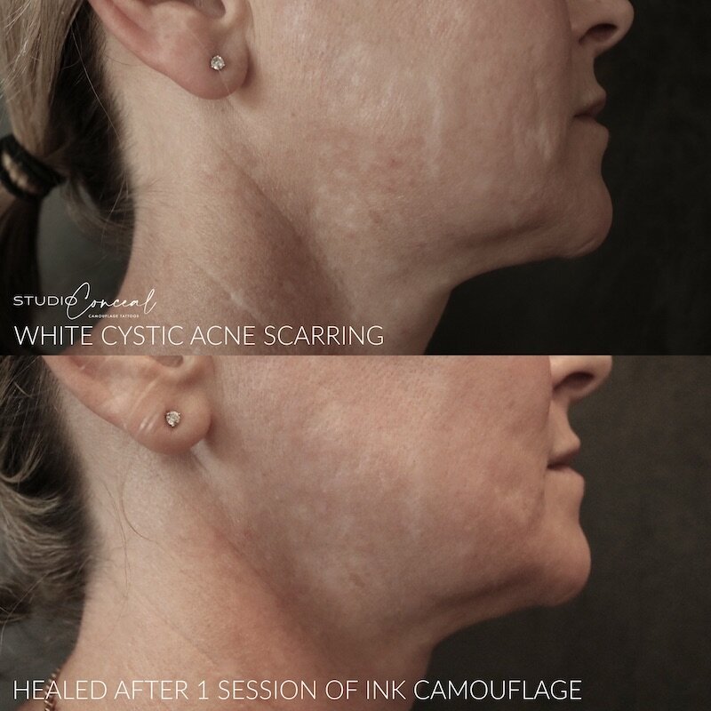  acne scar revision tattoo