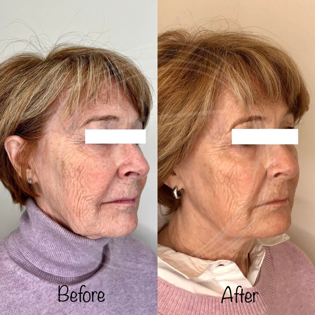 before:after results with look timeless -5