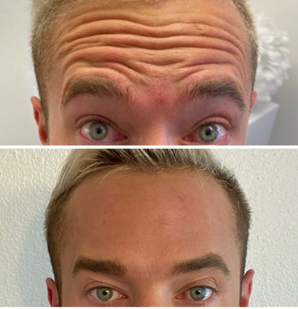 compressed-Neuromodulator-before-after-15