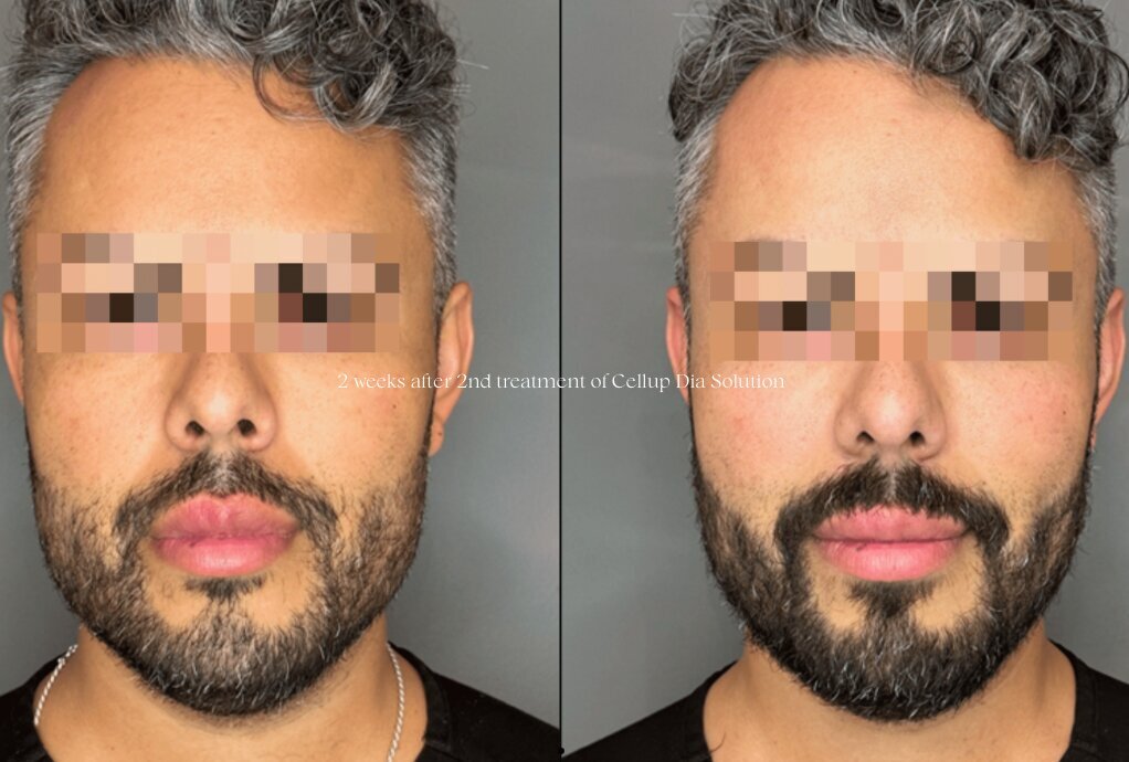 klaride-skin-booster-before-after-1