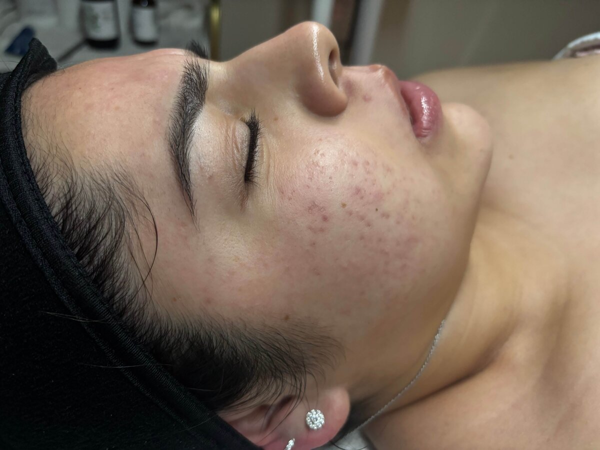 Santa-Barbara-Acne-Specialist_6285