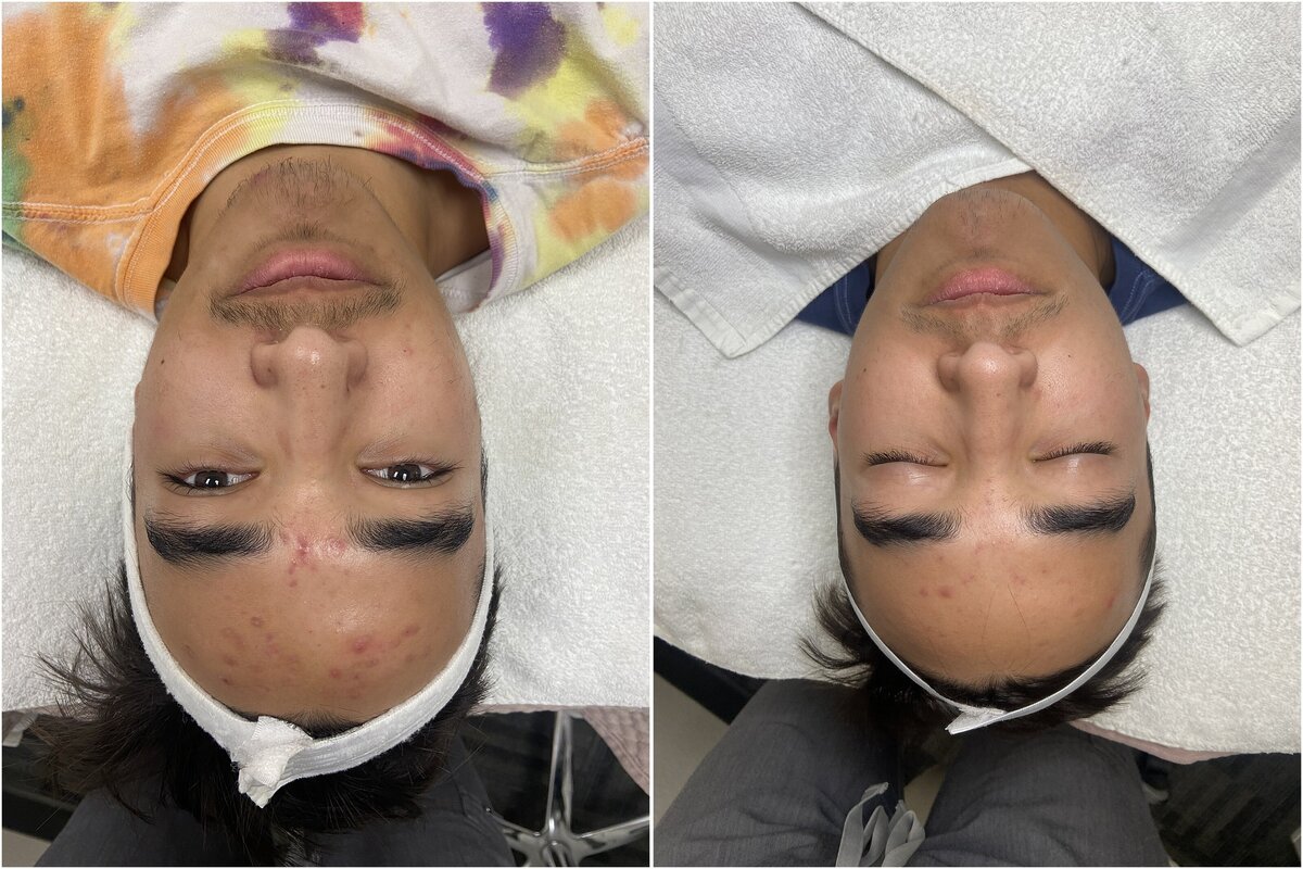 MK Studios_Allure AZ_acne-treatment-flagstaff-az-before-after_0020