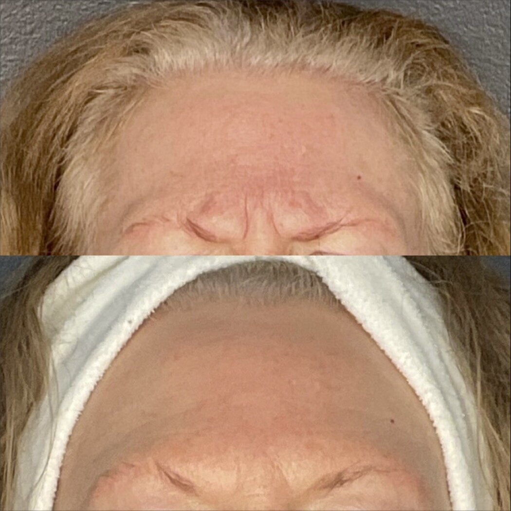 first time botox to glabella