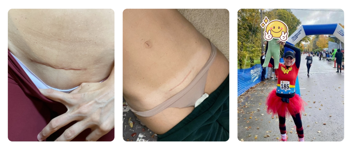 Amanda, return to running after C-section, 3 months to 8 months postpartum