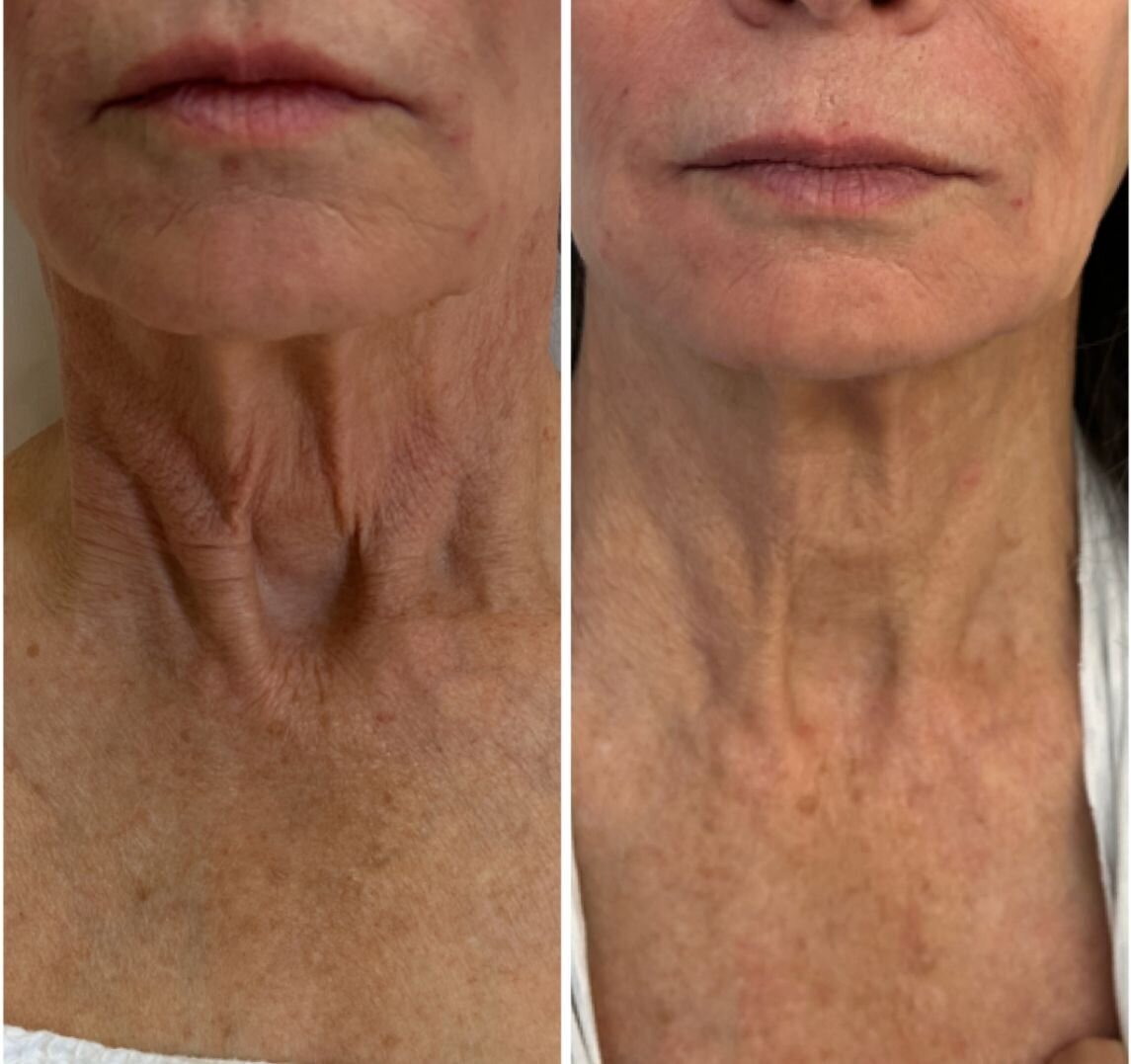 compressed-Hyperdilute-Radiesse-brand-and-before-after-09