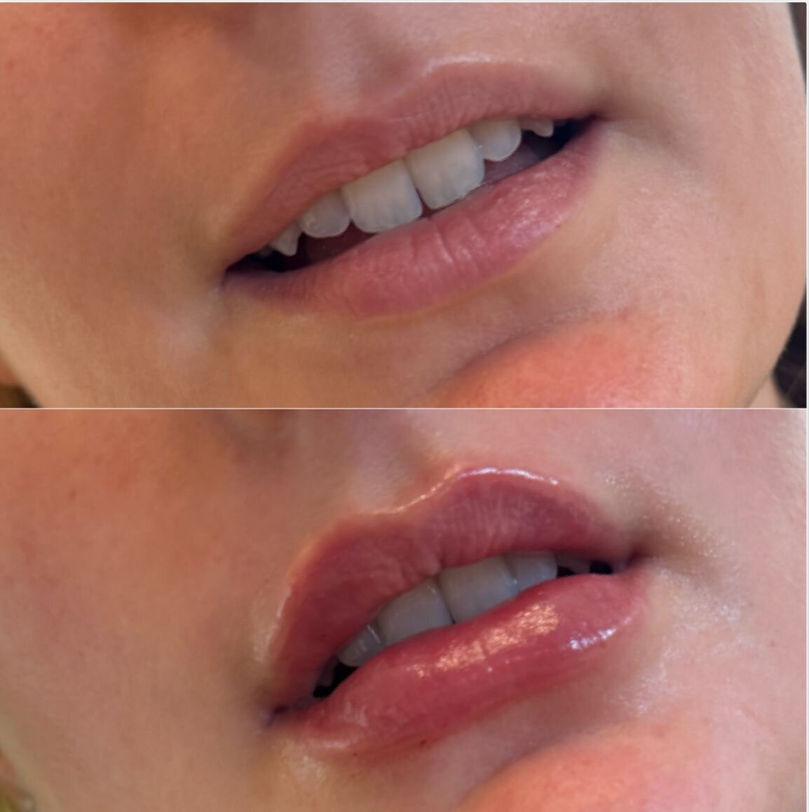 compressed-Lip-Wrinkles- Lip-volume-nd-some-brand-pics-16