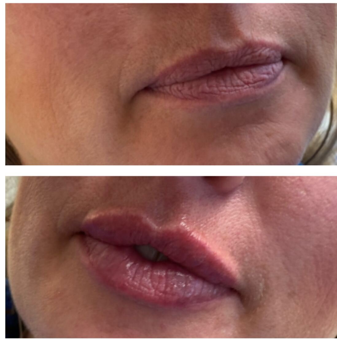 compressed-Lip-Wrinkles- Lip-volume-nd-some-brand-pics-29