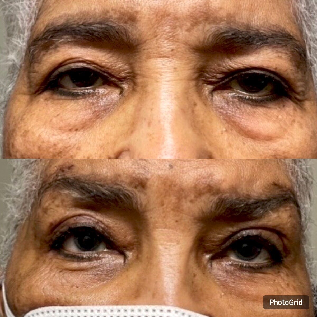 EYELID AND BROW LIFT