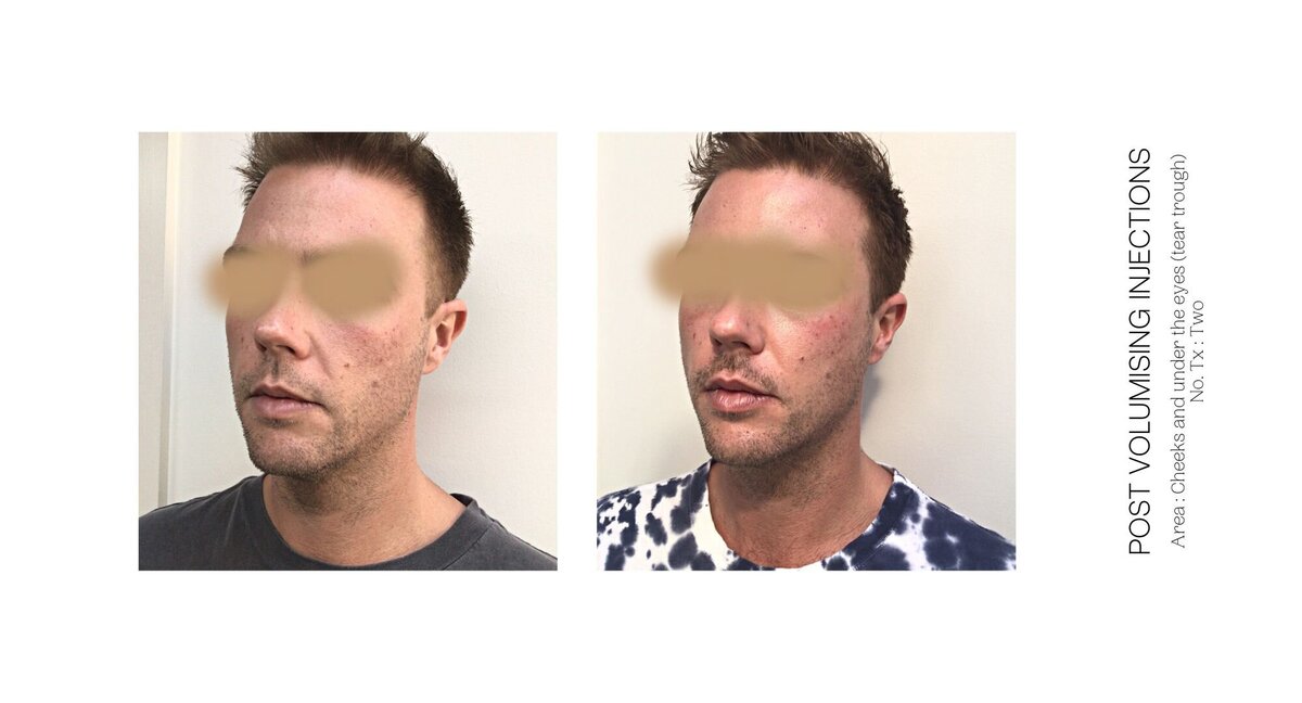 Male Under Eye Injection Before and After