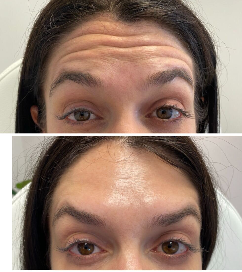 compressed-Neuromodulator-before-after-17