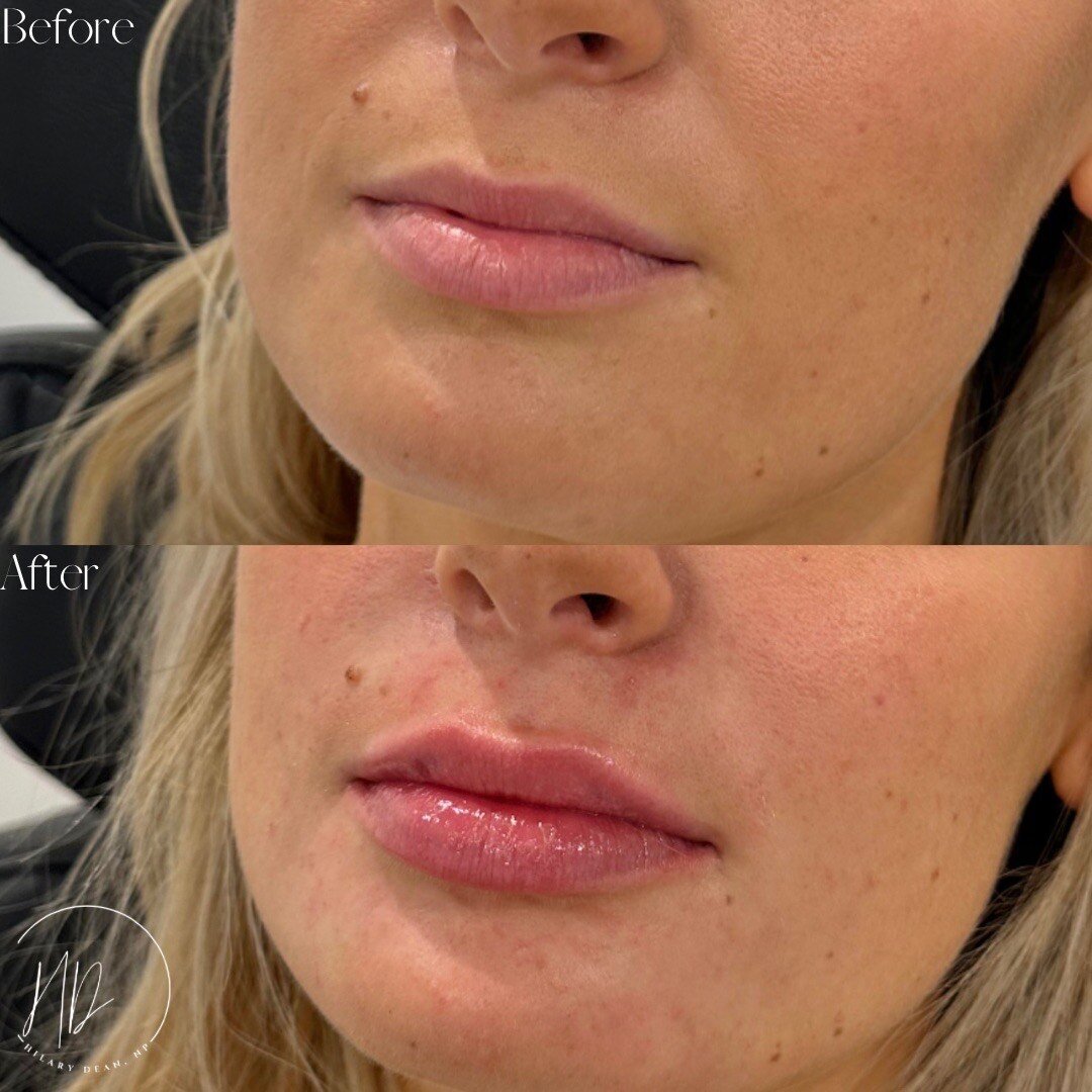 canova-aesthetics-med-spa-before-after-injectables-5