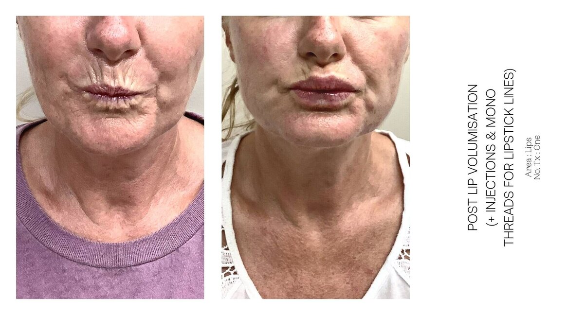 Best South Coast Lip Injection Before and After 53