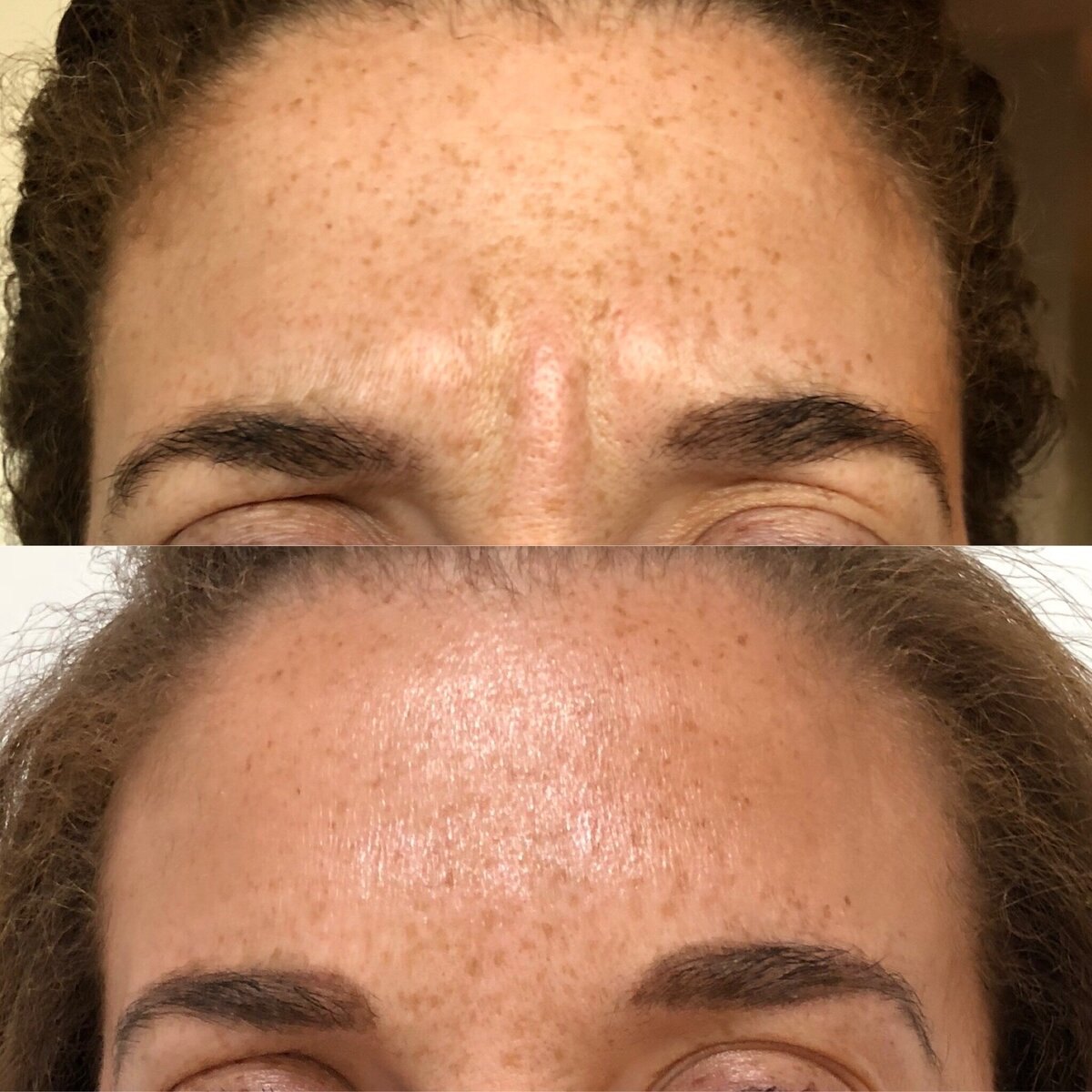 BalancedBeautyBotoxWestwood2