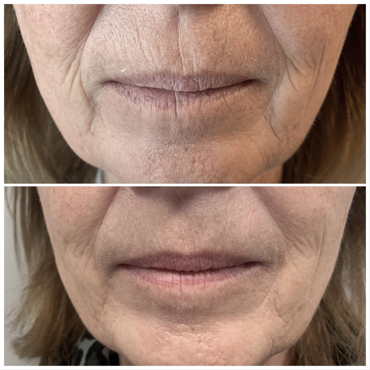 Fillers rimpels rond de lippen mond cosmetisch arts Rotterdam Lizenka Adriaanse