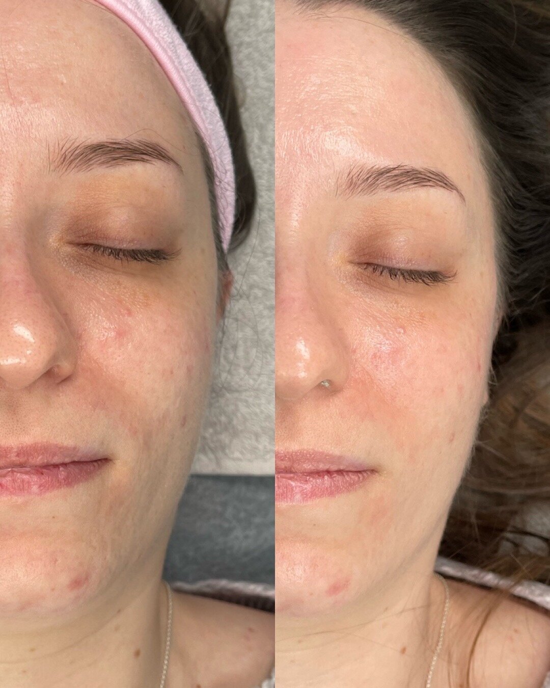 urglow bb glow before after judy
