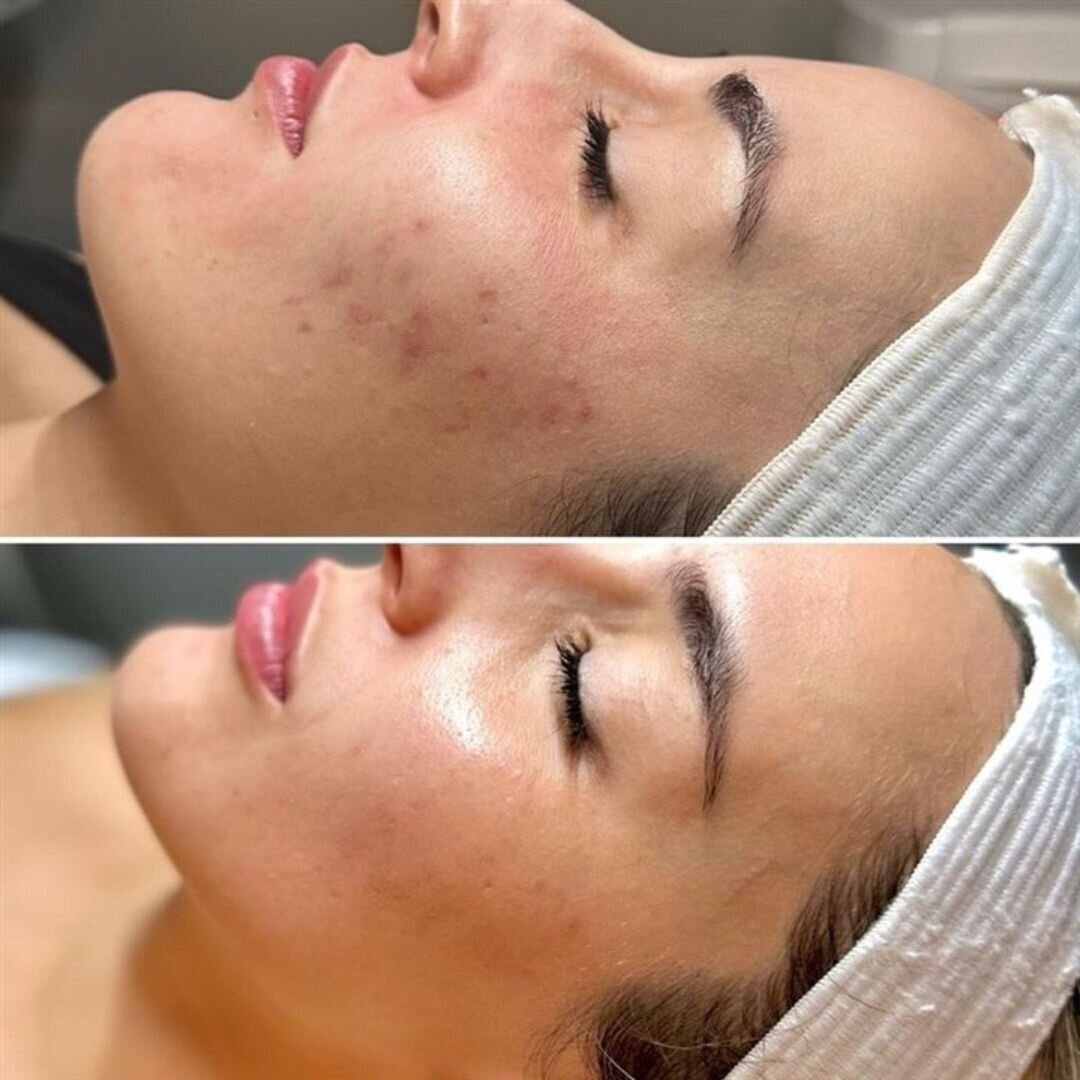 Microneedling before and after