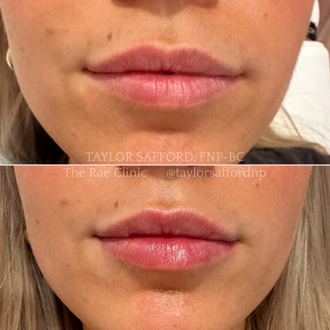 Lip Filler by Taylor Safford at The Rae Clinic in Augusta, GA