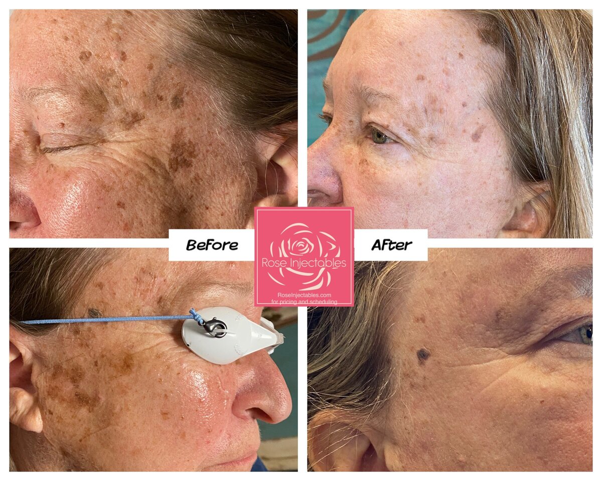 Lumecca-by-Rose-Injectables-Dark-Spot-Removal-Before-and-After-Photos-56