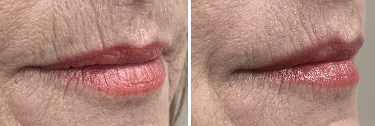 Lipfillers Rotterdam cosmetisch arts Lizenka Adriaanse