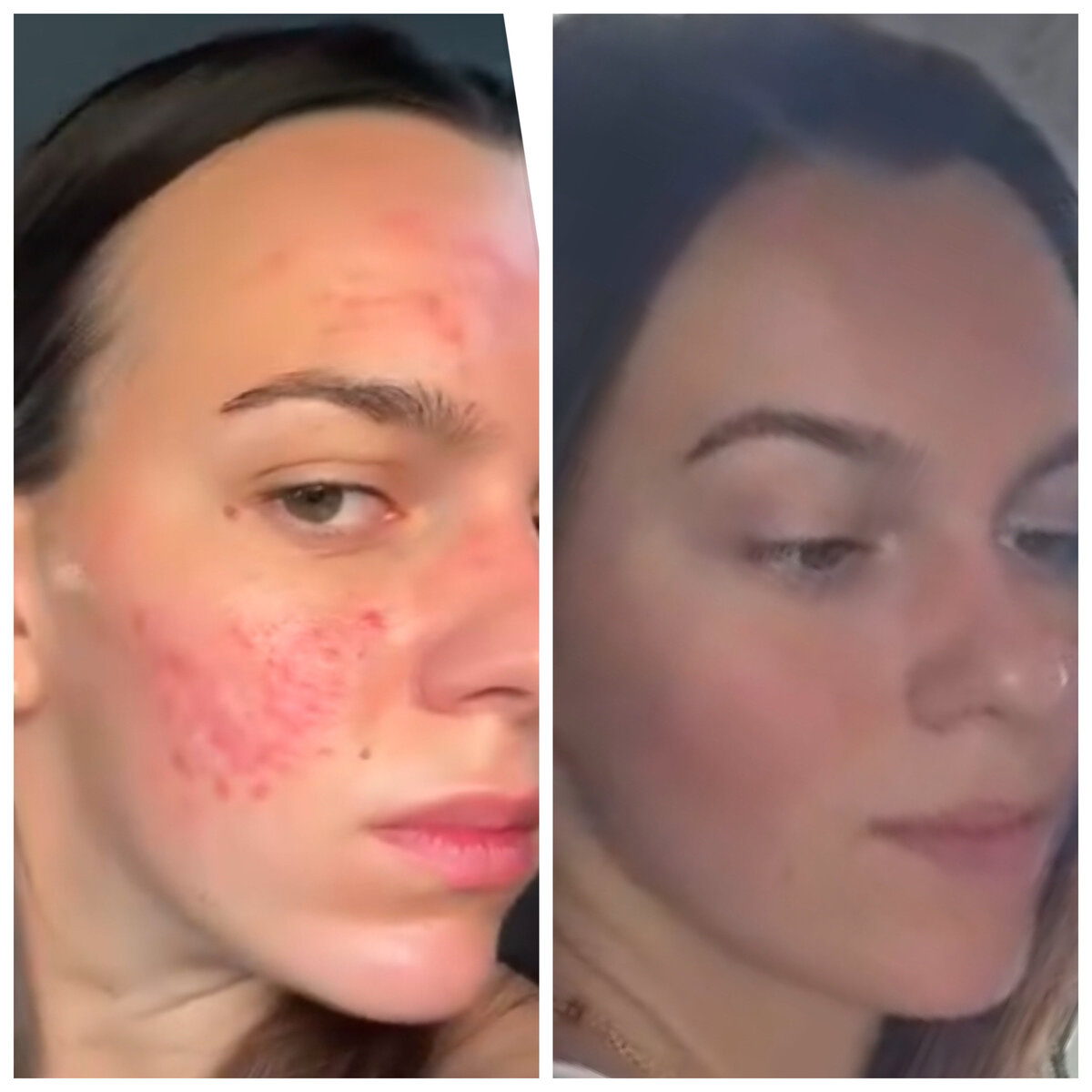Acne rosacea redness reduced naturally with Dr. Tara’s guidance and targeted nutrition.