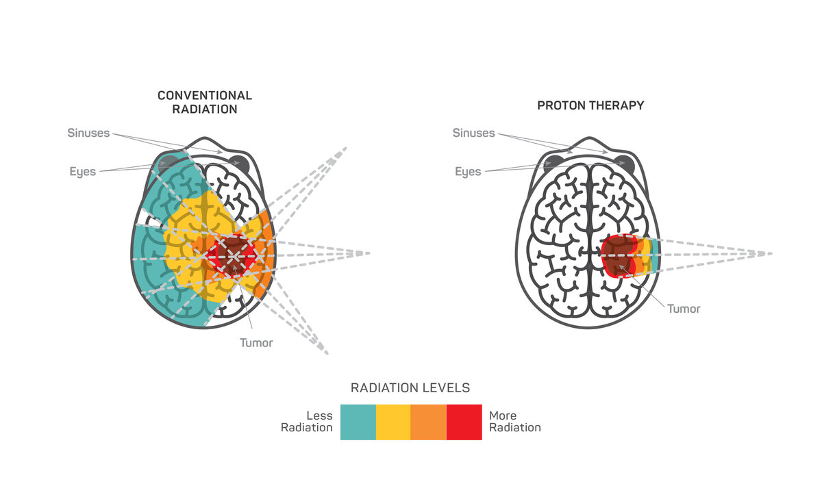 What is Proton Therapy?