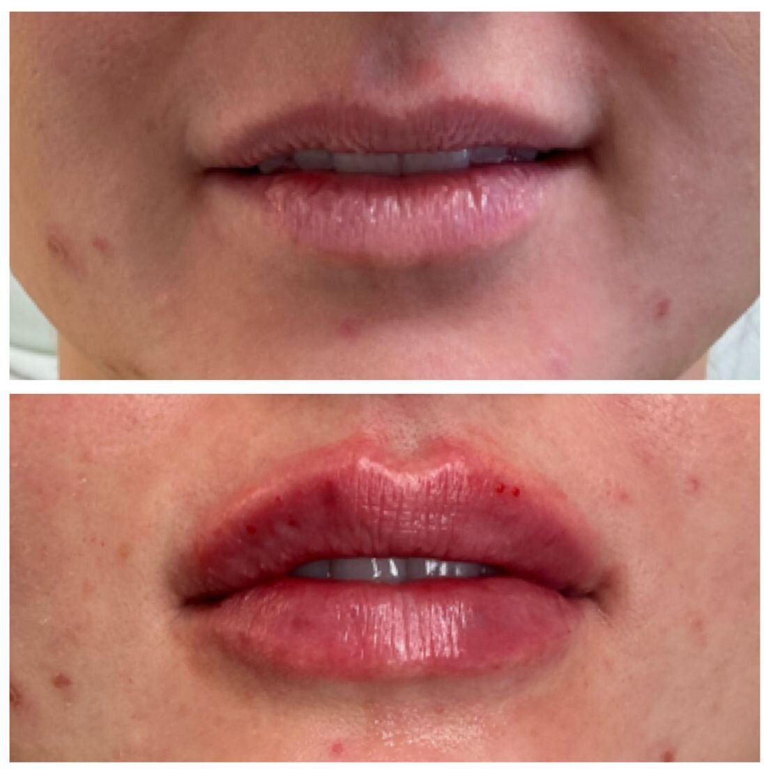 compressed-Lip-Wrinkles- Lip-volume-nd-some-brand-pics-06