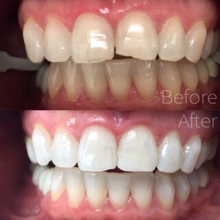 m20whitening20and20bonded20filling20on20a20chipped20upper20front20tooth.JPEG2