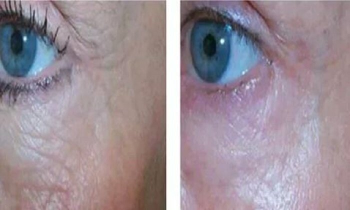 micropen-microneedling-before-and-after-4