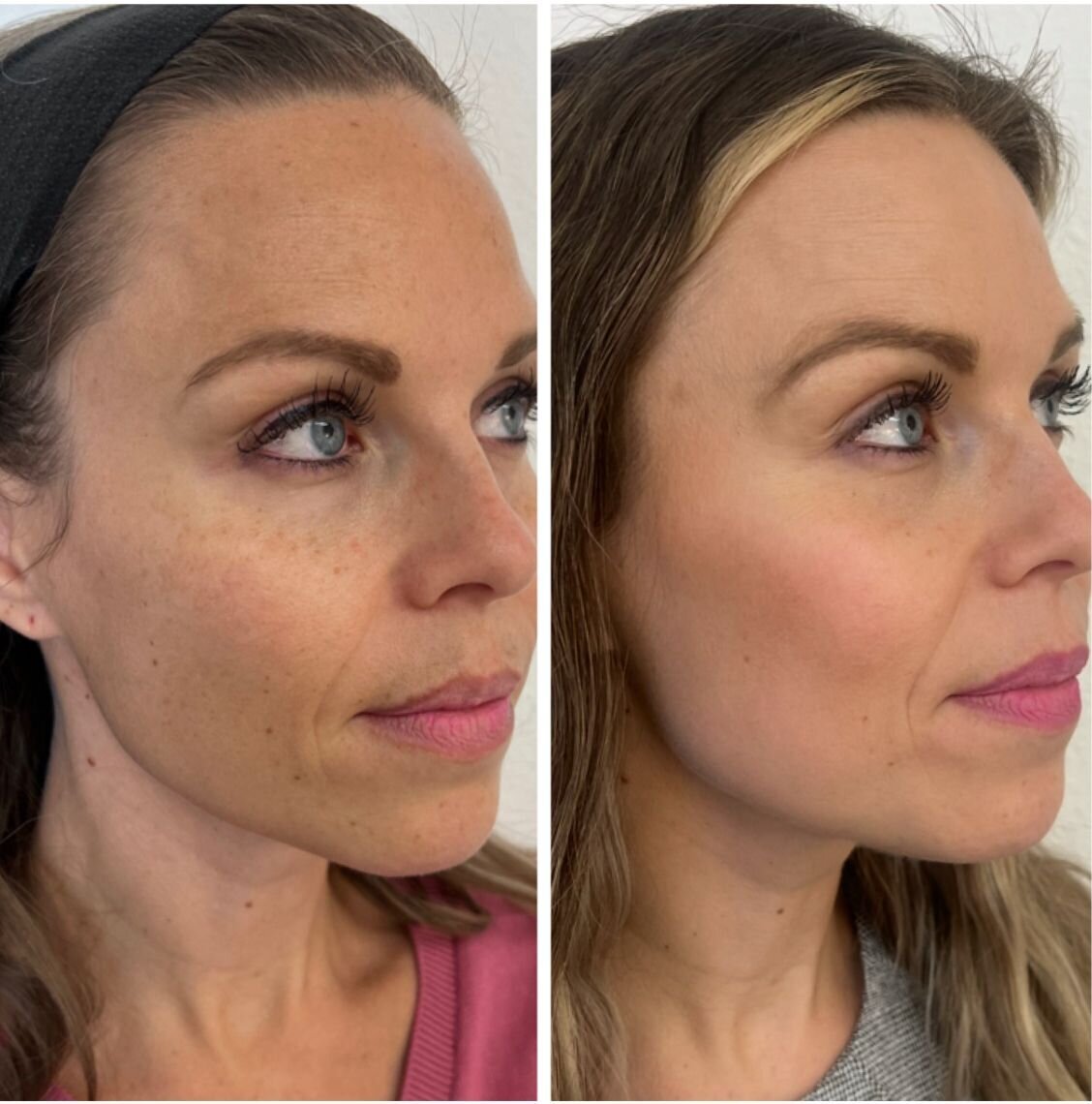 compressed-missing-laser-images-before-after-06