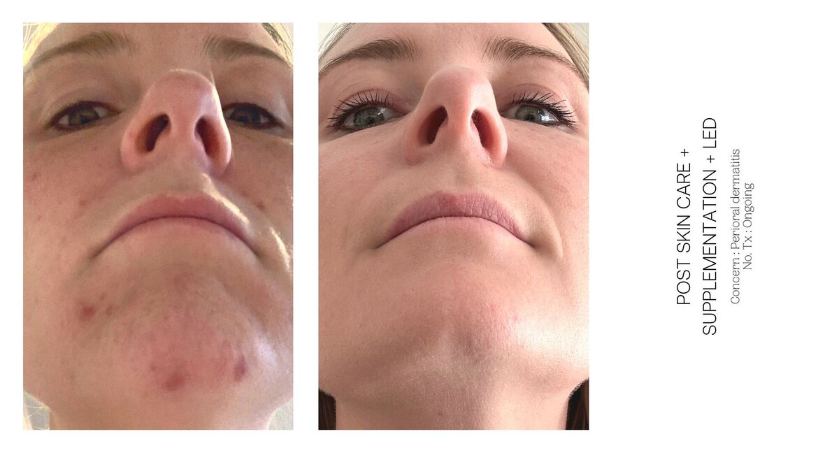 Perioral Dermatitis Before and After 1