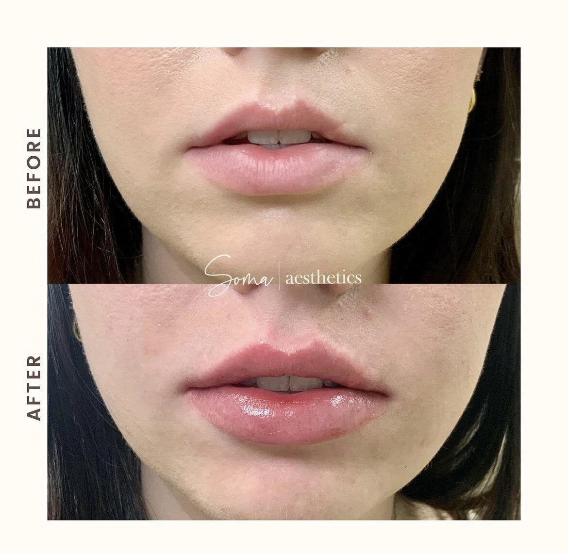 Lip Filler 2