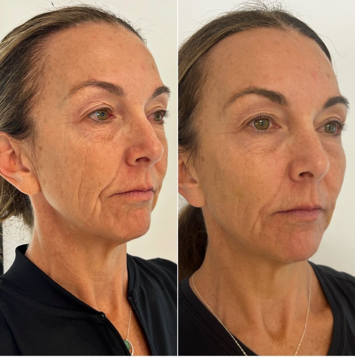 compressed-Hyperdilute-Radiesse-brand-and-before-after-07