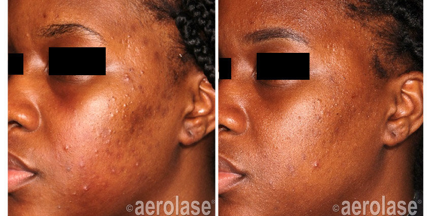 NeoClear Acne - After 4 Treatments - Michelle Henry MD