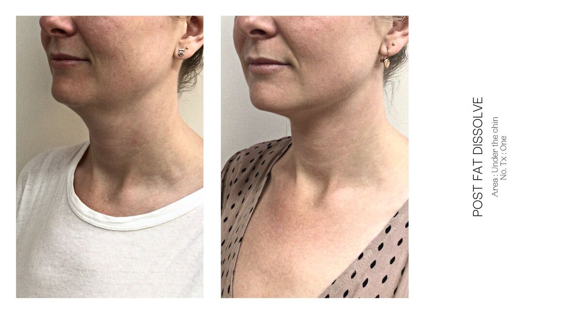 Under Chin Fat Dissolve Before and After 10