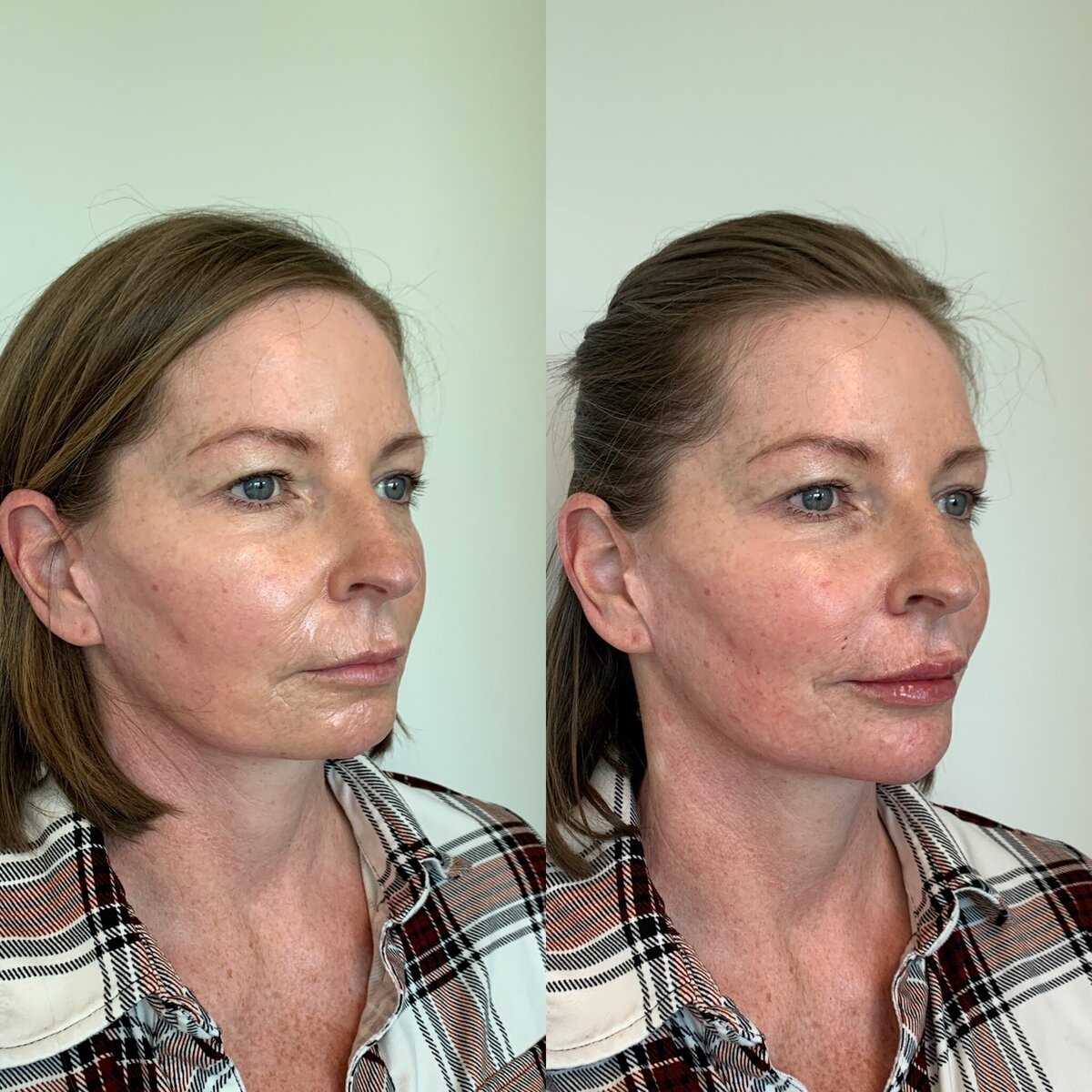 BalancedBeautyBotoxWestwood9