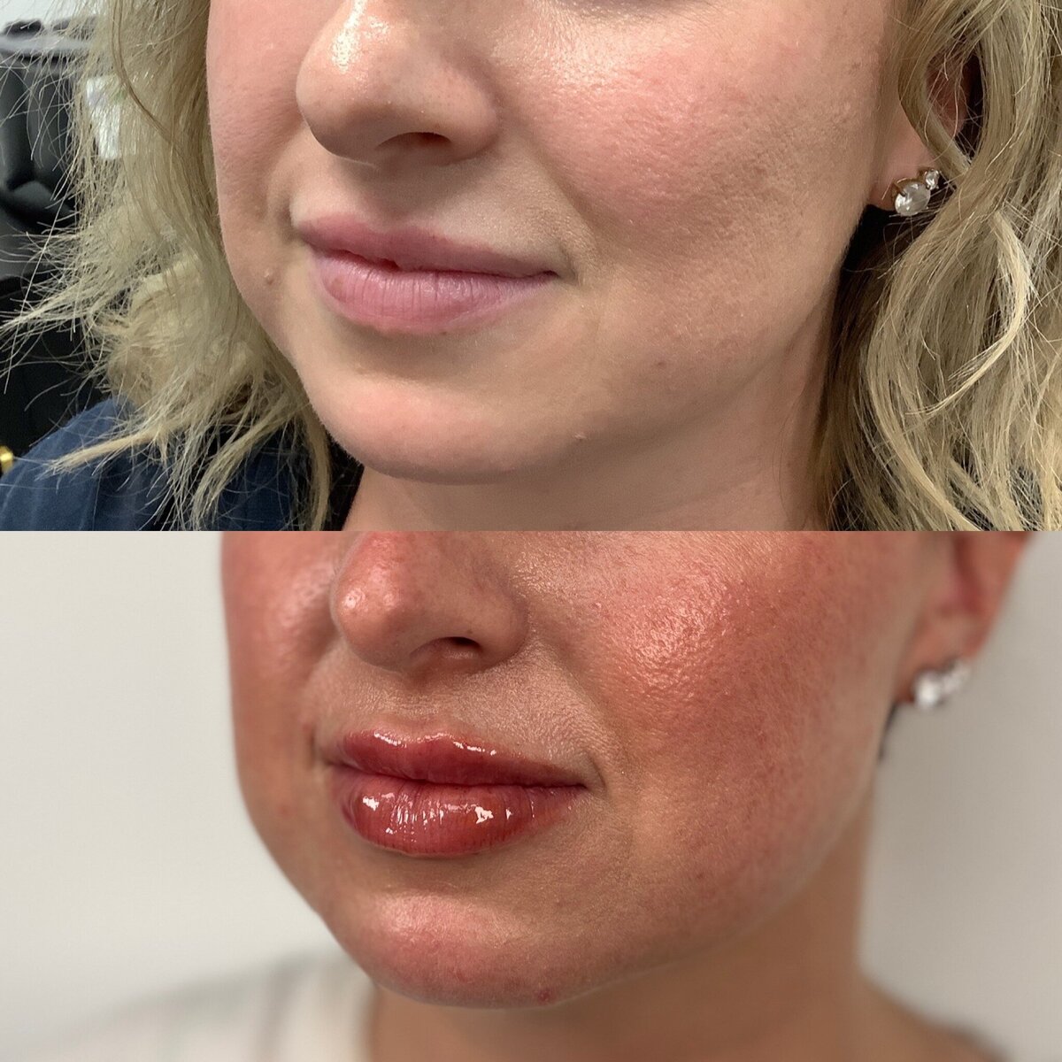 lip filler correction