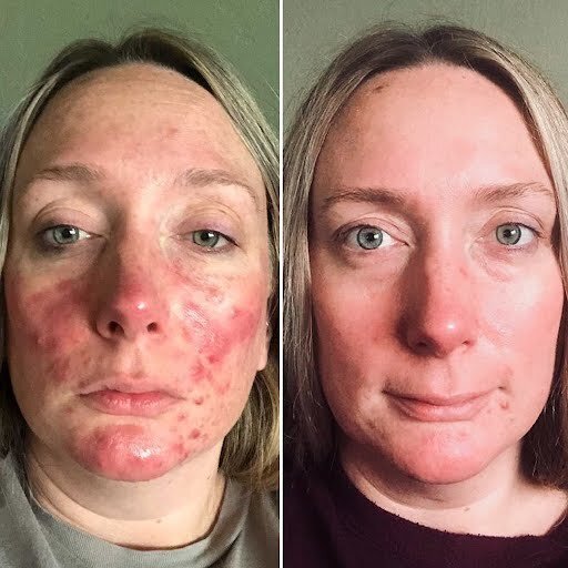 Rosacea Transformation Photos The Rosacea Method Successes