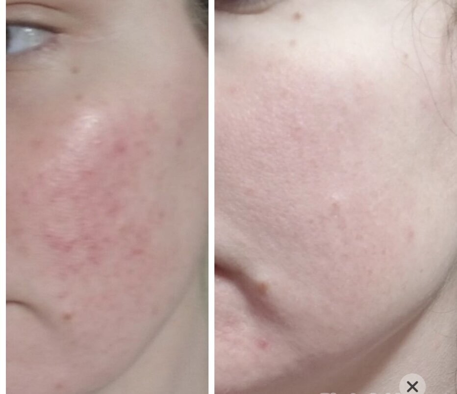 Clearer skin achieved through The Rosacea Method’s focus on internal healing and holistic care.