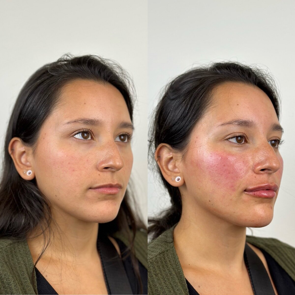 Full Facial Balancing with Botox & Fillers