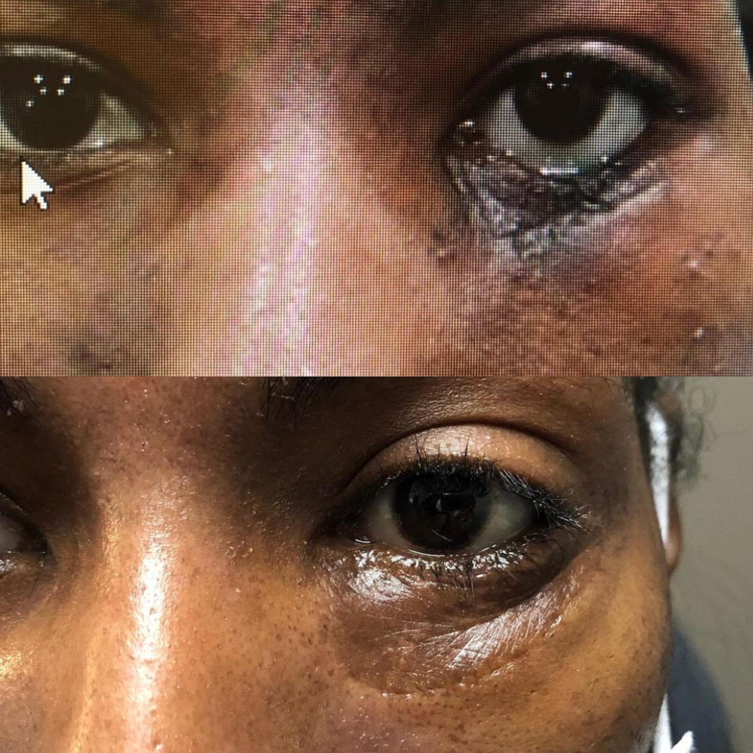 Lower eyelid reconstruction with skin graft