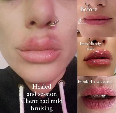 lip1