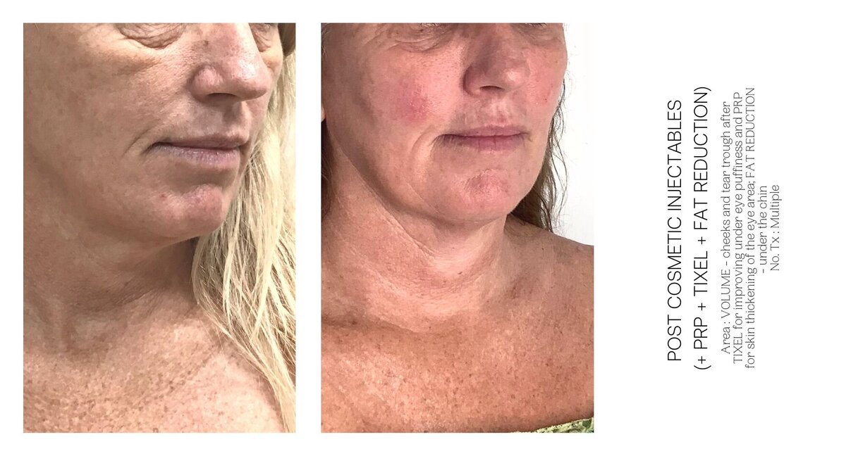 Cosmetic Injectable PRP and Tixel Before and After
