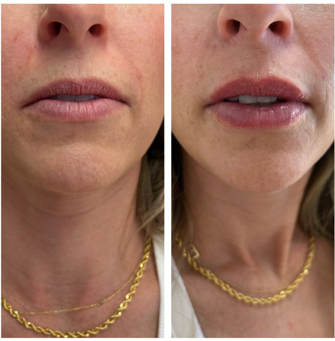 compressed-Lip-Wrinkles- Lip-volume-nd-some-brand-pics-27