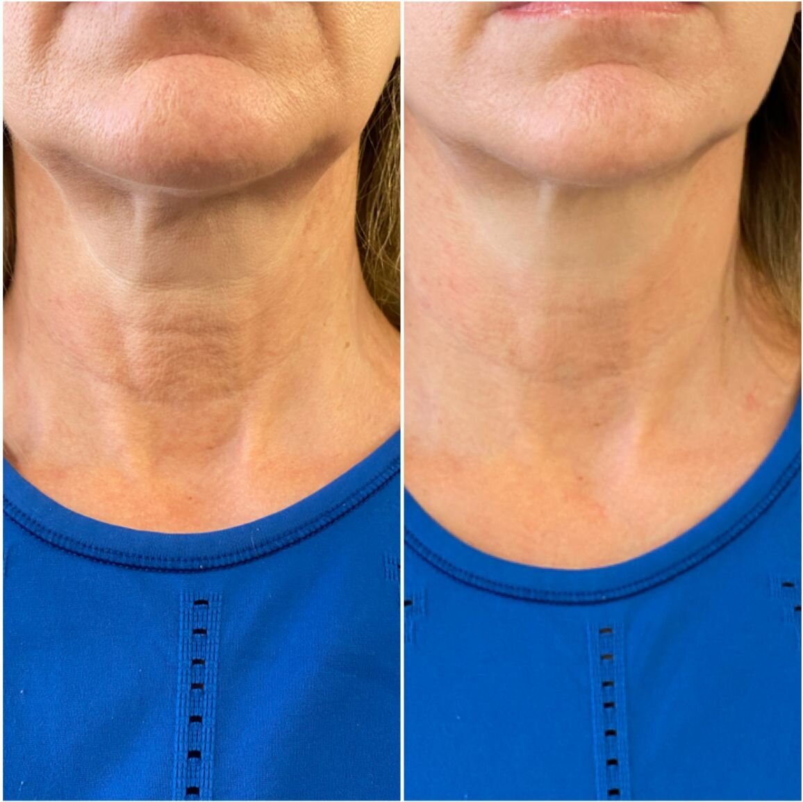 compressed-Hyperdilute-Radiesse-brand-and-before-after-10