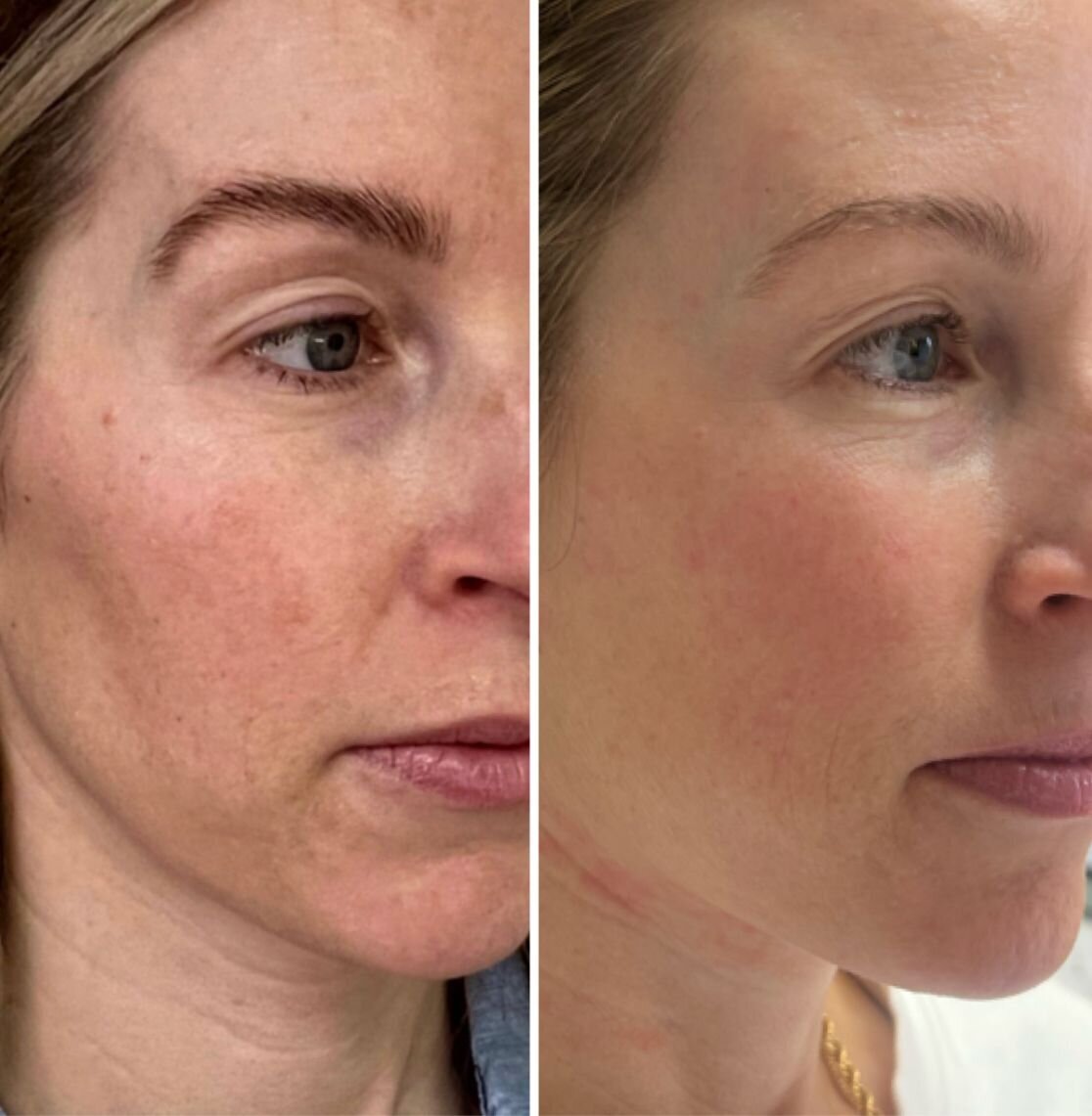 bbl-before-after-05