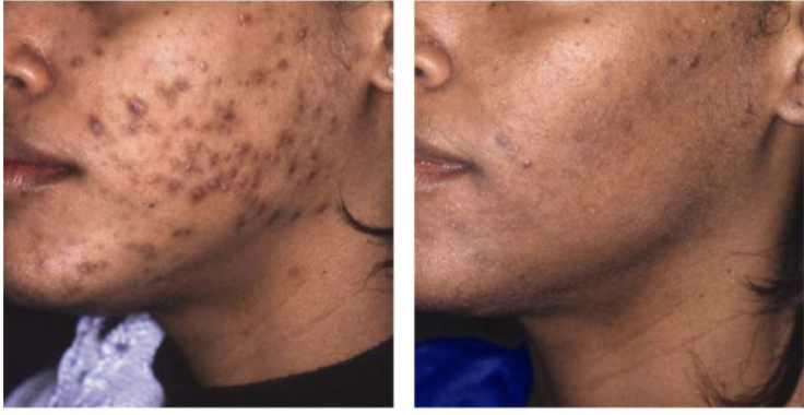 before and after - acne and hyperpigmentation