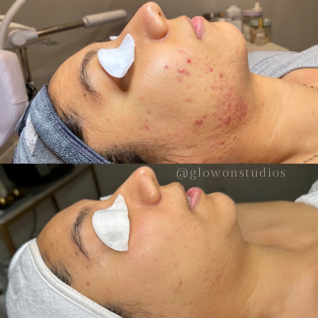 Glow-On-Studios-Before-After-Skincare-Sacramento-8